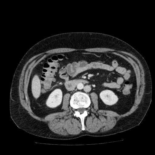 Acute cholecystitis and incidental left sided IVC (Radiopaedia 49352-54459 Axial C+ portal venous phase 78).jpg