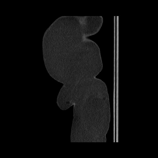 Acute cholecystitis with tensile fundus sign (Radiopaedia 71394-81723 Sagittal non-contrast 164).jpg