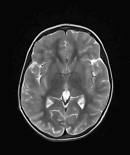 File:Acute disseminating encephalomyelitis with bilateral optic neuritis (Radiopaedia 79676-92886 Axial T2 13).jpg