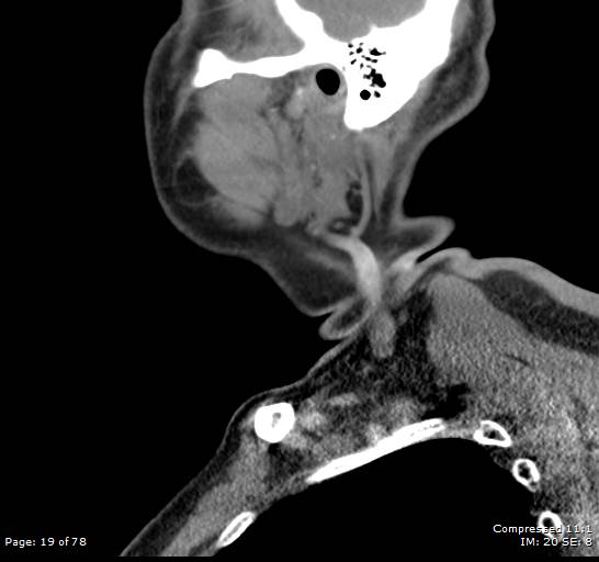 File:Acute epiglottitis (Radiopaedia 54375-60590 Sagittal 43).jpg