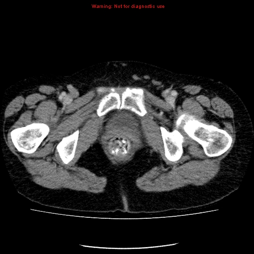 Acute gangrenous cholecystitis (Radiopaedia 10123-10661 Axial C+ portal venous phase 103).jpg