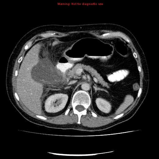 Acute gangrenous cholecystitis (Radiopaedia 10123-10661 Axial C+ portal venous phase 31).jpg