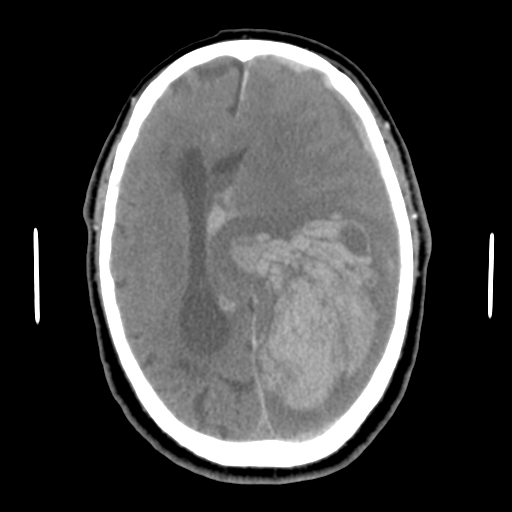 Acute hemorrhagic stroke (Radiopaedia 17507-17223 Axial non-contrast 31).jpg