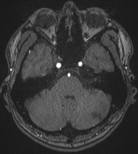 Acute left middle cerebral artery territory infarct with clot retrieval (Radiopaedia 47732-52433 Axial MRA 15).png