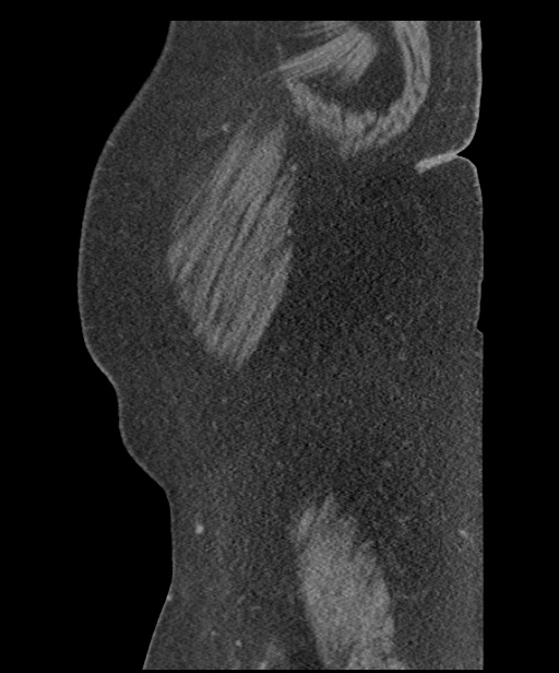 Acute mesenteric venous ischemia (Radiopaedia 46041-50383 Sagittal C+ portal venous phase 2).jpg