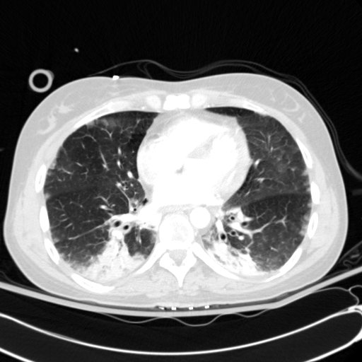 Acute myocardial infarction in CT (Radiopaedia 39947-42415 Axial lung window 81).jpg