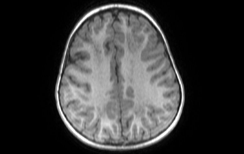 Acute necrotizing encephalitis of childhood (Radiopaedia 67356-76737 Axial T1 28).jpg