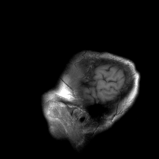 File:Acute necrotizing toxoplasma encephalitis (Radiopaedia 10683-11149 Sagittal T1 fat sat 1).jpg