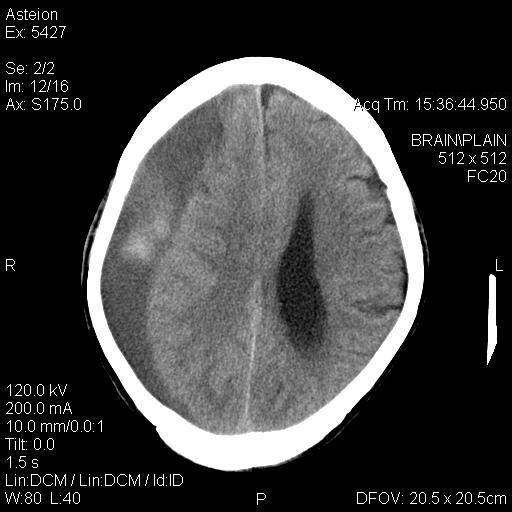 File:Acute on chronic sub-dural hematoma (Radiopaedia 5227-6992 D 1).jpg