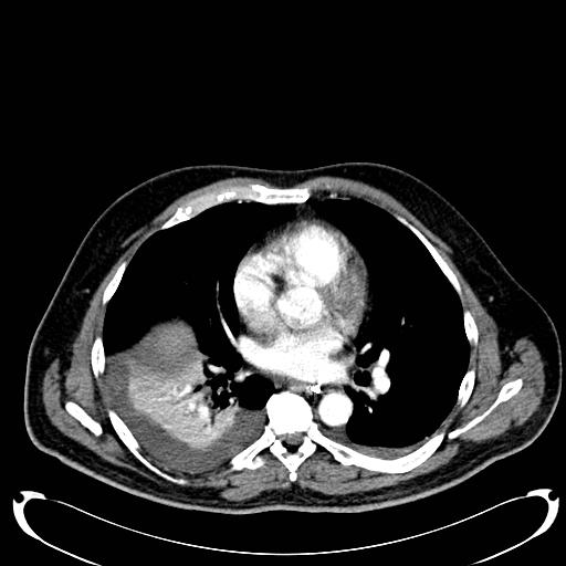 File:Acute pancreatic necrosis (Radiopaedia 13560-18500 Axial C+ portal venous phase 3).jpg