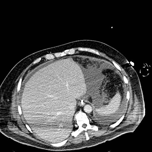 Acute pancreatic necrosis (Radiopaedia 13560-18501 Axial C+ portal venous phase 15).jpg