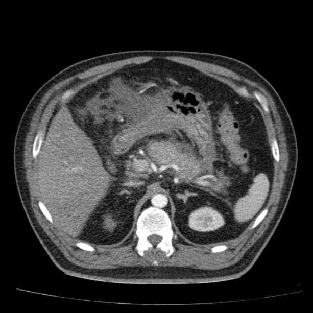 Acute pancreatitis (Radiopaedia 26663-26813 Axial C+ arterial phase 32).jpg