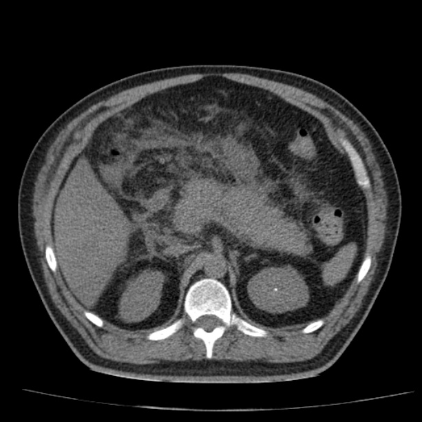 Acute pancreatitis (Radiopaedia 26663-26813 Axial non-contrast 35).jpg