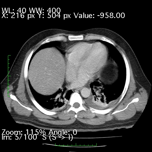 File:Acute pancreatitis (Radiopaedia 34043-35276 Axial C+ portal venous phase 5).jpg