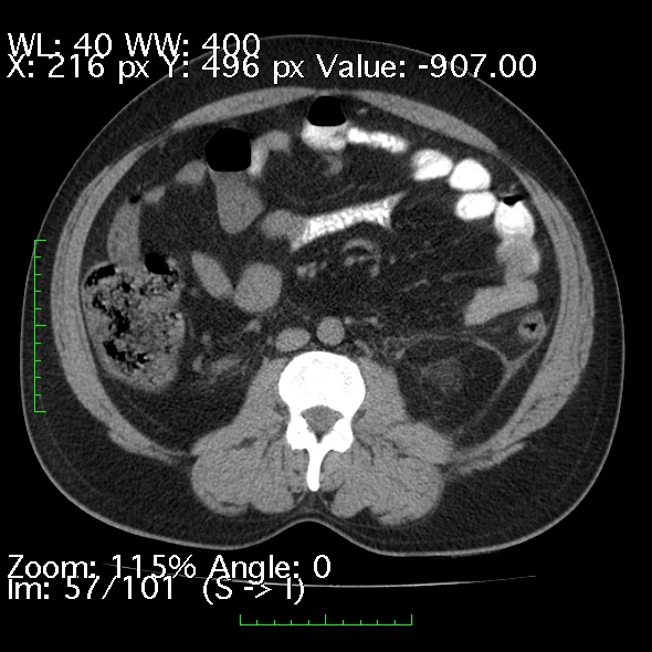 Acute pancreatitis (Radiopaedia 34043-35276 Axial non-contrast 57).jpg