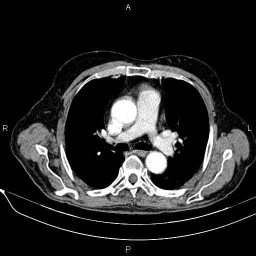 File:Acute pancreatitis (Radiopaedia 85146-100701 Axial C+ arterial phase 4).jpg