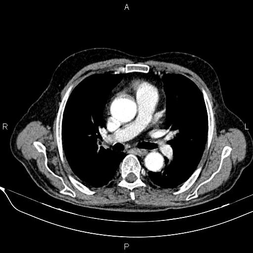 File:Acute pancreatitis (Radiopaedia 85146-100701 Axial C+ arterial phase 6).jpg