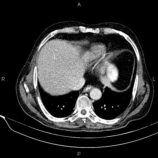 Acute pancreatitis (Radiopaedia 85146-100701 Axial C+ portal venous phase 12).jpg