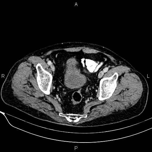 Acute pancreatitis (Radiopaedia 85146-100701 Axial C+ portal venous phase 57).jpg