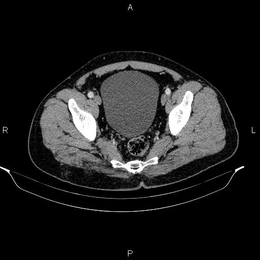 Acute pancreatitis (Radiopaedia 85390-101010 Axial C+ portal venous phase 95).jpg