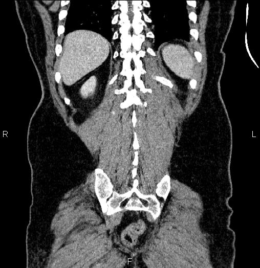 File:Acute pancreatitis (Radiopaedia 85390-101010 Coronal C+ portal venous phase 63).jpg