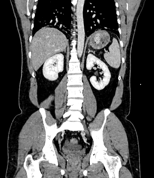 Acute pancreatitis (Radiopaedia 87428-103757 Coronal C+ portal venous phase 63).jpg