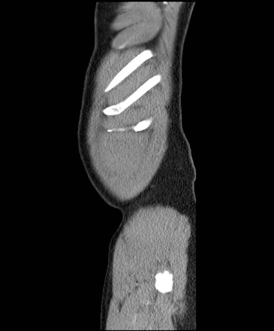 Acute pancreatitis - Balthazar E (Radiopaedia 23080-23110 Sagittal C+ portal venous phase 1).jpg
