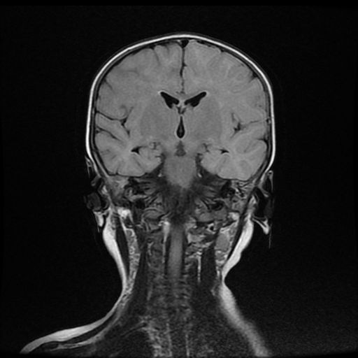 File:Acute phase of hemiconvulsion-hemiplegia epilepsy syndrome (Radiopaedia 29309-29745 Coronal FLAIR 12).jpg