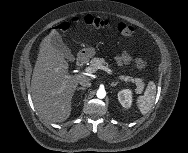 Acute pulmonary embolism with pulmonary infarcts (Radiopaedia 77688-89908 Axial C+ CTPA 81).jpg