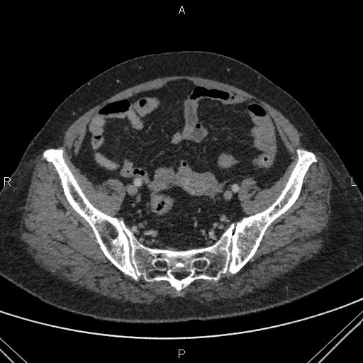 File:Acute renal artery occlusion (Radiopaedia 86586-102682 Axial C+ portal venous phase 78).jpg