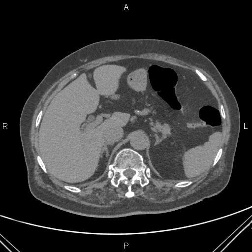 Acute renal artery occlusion (Radiopaedia 86586-102682 Axial non-contrast 17).jpg