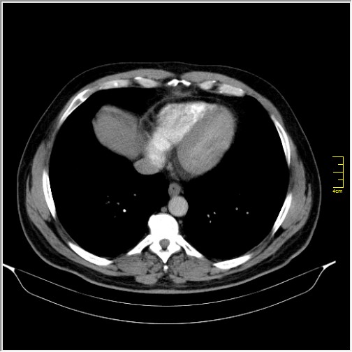 Acute right sided diverticulitis (Radiopaedia 65249-74268 Axial C+ portal venous phase 2).JPG