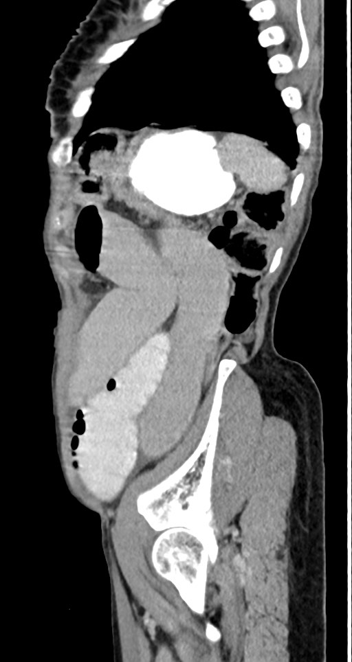 Acute small bowel (ileal) volvulus (Radiopaedia 71740-82139 Sagittal C+ portal venous phase 41).jpg