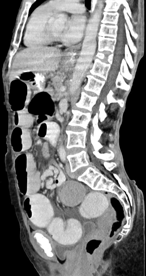 Acute small bowel (ileal) volvulus (Radiopaedia 71740-82139 Sagittal C+ portal venous phase 83).jpg