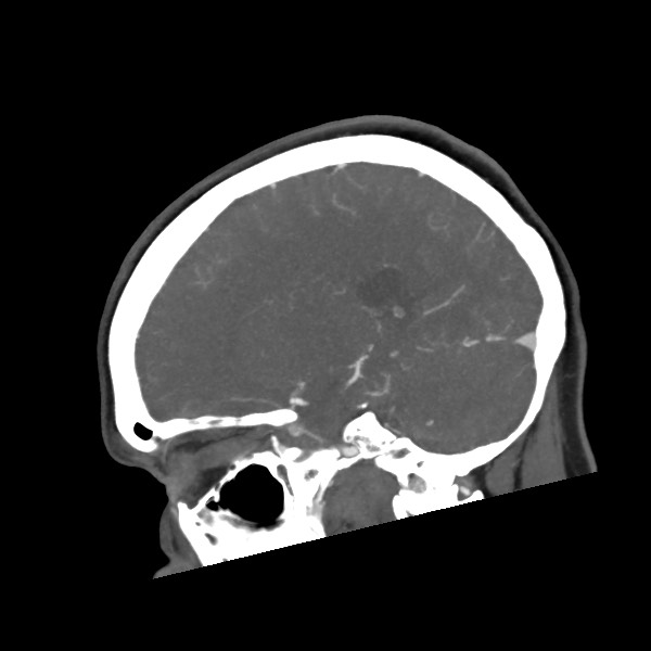 Acute subarachnoid hemorrhage and accessory anterior cerebral artery (Radiopaedia 69231-79009 Sagittal C+ arterial phase 46).jpg