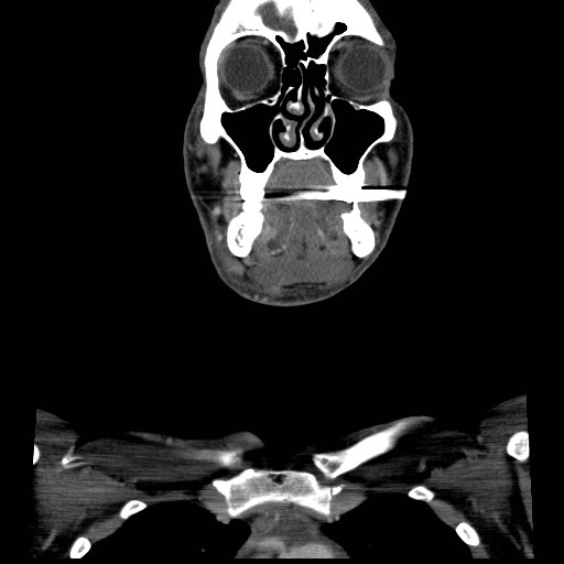 File:Acute submandibular sialadenitis secondary to ductal stone (Radiopaedia 27999-28267 D 16).jpg