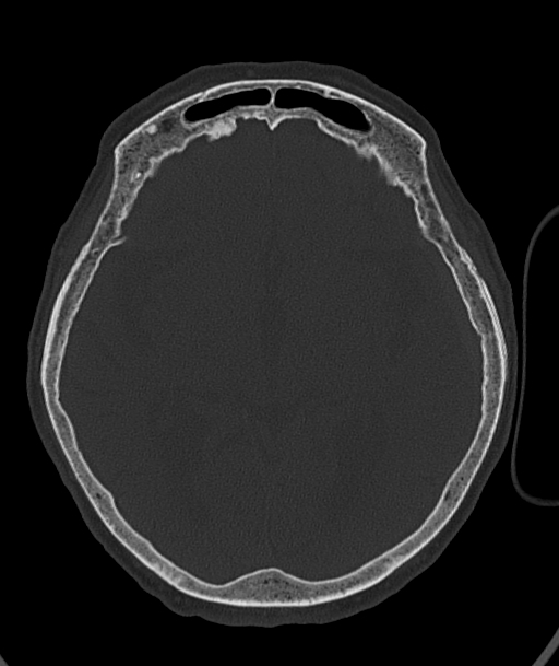 Acute traumatic subdural hematoma (Radiopaedia 82921-97257 Axial bone window 60).jpg