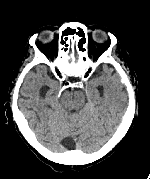 Acute traumatic subdural hematoma (Radiopaedia 82921-97257 Axial non-contrast 43).jpg