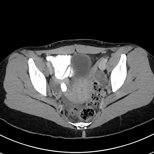 Acute uncomplicated appendicitis (Radiopaedia 61374-69304 Axial C+ portal venous phase 112).jpg