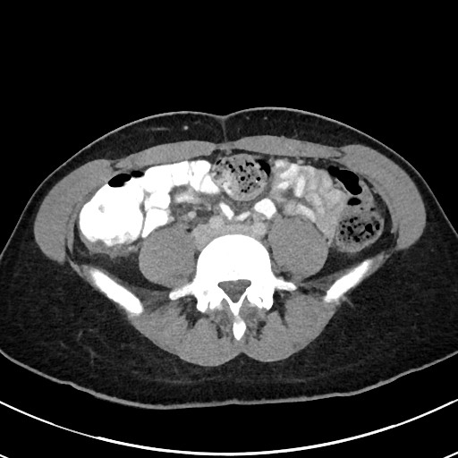 Acute uncomplicated appendicitis (Radiopaedia 61374-69304 Axial C+ portal venous phase 74).jpg