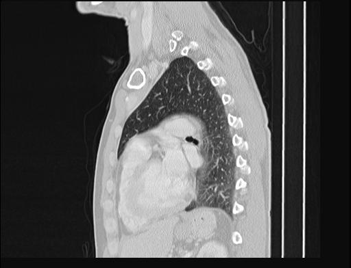 File:Addison disease (Radiopaedia 49318-54412 Sagittal lung window 24).jpg