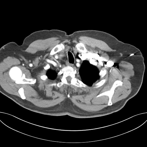 Adenocarcioma of rectum- T1 lesion (Radiopaedia 36921-38547 Axial C+ arterial phase 9).png