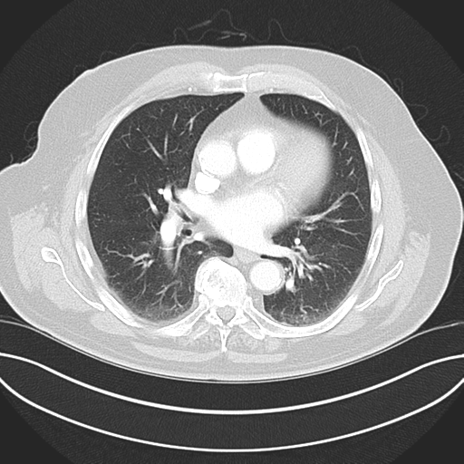 Adenocarcioma of rectum- T1 lesion (Radiopaedia 36921-38547 Axial lung window 31).png