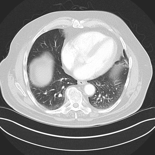 Adenocarcioma of rectum- T1 lesion (Radiopaedia 36921-38547 Axial lung window 38).png