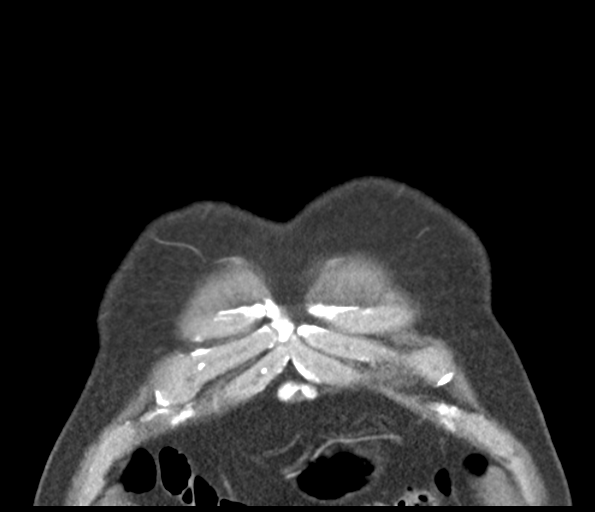 Adenocarcioma of rectum- T1 lesion (Radiopaedia 36921-38547 Coronal C+ arterial phase 8).png