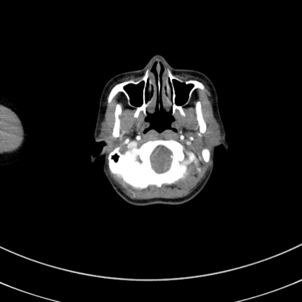 File:Adenocystic carcinoma of the trachea (Radiopaedia 47677-52525 Axial C+ arterial phase 5).jpg