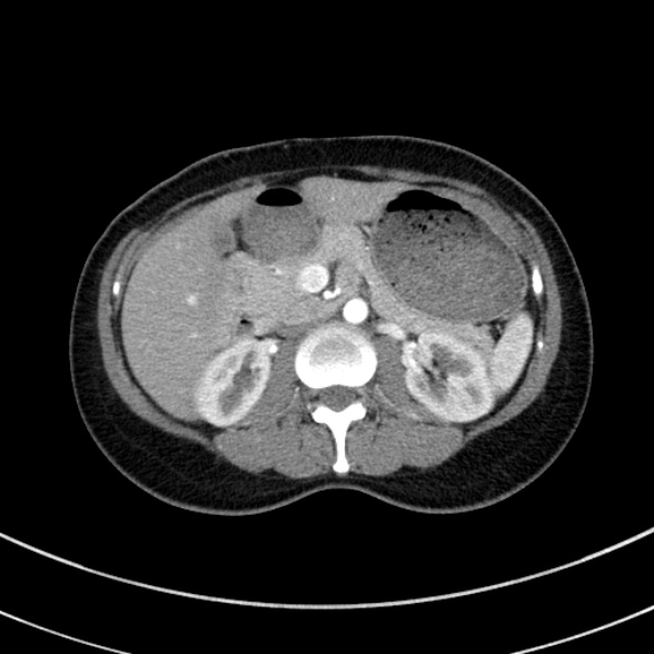 Adenocystic carcinoma of the trachea (Radiopaedia 47677-52525 Axial C+ arterial phase 86).jpg