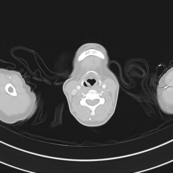 Adenocystic carcinoma of the trachea (Radiopaedia 47677-52525 Axial lung window 18).jpg