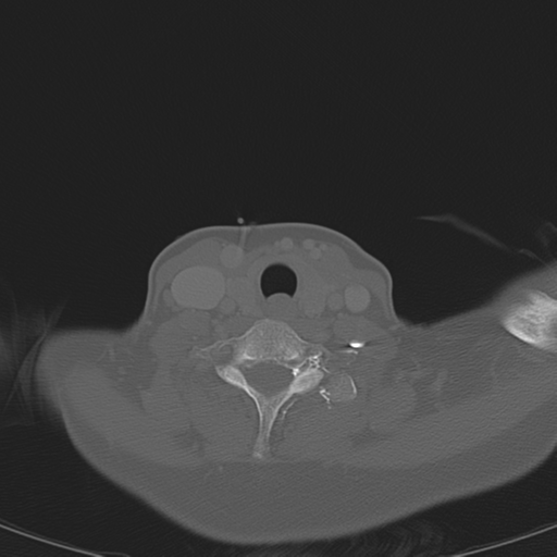 File:Adenoid cystic tumor of palate (Radiopaedia 46980-51518 Axial bone window 57).png