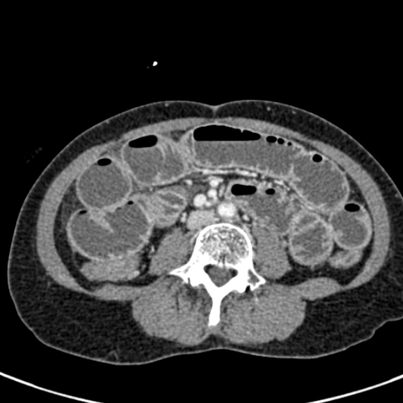 File:Adhesional small bowel obstruction (Radiopaedia 48397-53305 Axial C+ portal venous phase 50).jpg